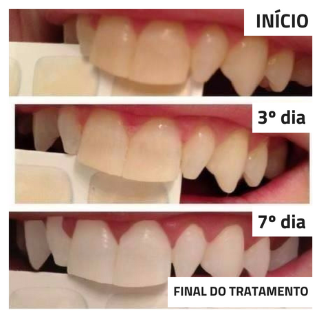 Kit de Blanqueamiento Dental, LuzBrilho®